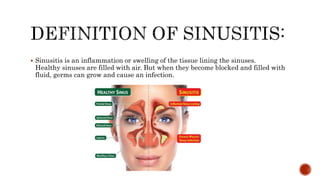 Sinus : définition et explications