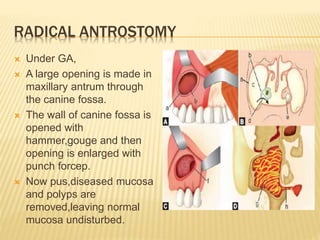 RADICAL ANTROSTOMY
 Under GA,
 A large opening is made in
maxillary antrum through
the canine fossa.
 The wall of canine fossa is
opened with
hammer,gouge and then
opening is enlarged with
punch forcep.
 Now pus,diseased mucosa
and polyps are
removed,leaving normal
mucosa undisturbed.
 
