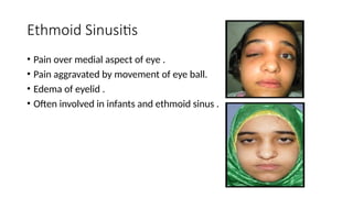 Comprehensive Overview of Sinusitis: Classification, Pathology, and ...