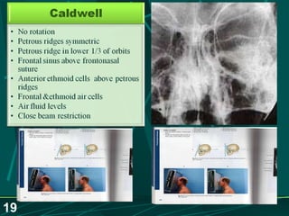 Sinusitis.. Dr.Prashant Modi