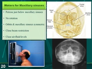 Sinusitis.. Dr.Prashant Modi