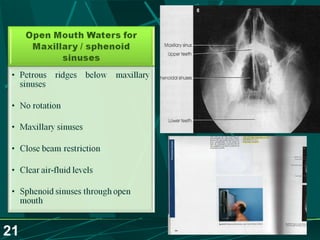Sinusitis.. Dr.Prashant Modi