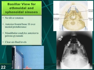 Sinusitis.. Dr.Prashant Modi