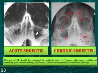 Sinusitis.. Dr.Prashant Modi