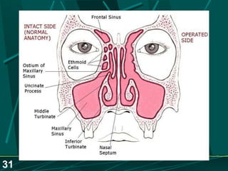 Sinusitis.. Dr.Prashant Modi
