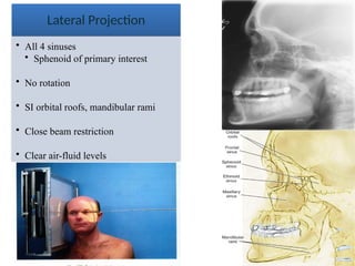 31
Lateral Projection
• All 4 sinuses
• Sphenoid of primary interest
• No rotation
• SI orbital roofs, mandibular rami
• Close beam restriction
• Clear air-fluid levels
 