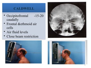 32
CALDWELL
• Occipitofrontal -15-20
caudally
• Frontal &ethmoid air
cells
• Air fluid levels
• Close beam restriction
 