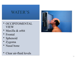 33
WATER’S
• OCCIPITOMENTAL
VIEW
• Maxilla & orbit
• Frontal
• Sphenoid
• Zygoma
• Nasal bone
• Clear air-fluid levels
 