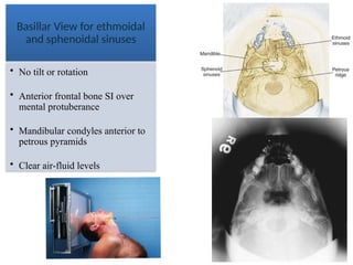 36
Basillar View for ethmoidal
and sphenoidal sinuses
• No tilt or rotation
• Anterior frontal bone SI over
mental protuberance
• Mandibular condyles anterior to
petrous pyramids
• Clear air-fluid levels
 