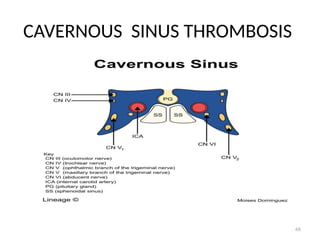68
CAVERNOUS SINUS THROMBOSIS
 
