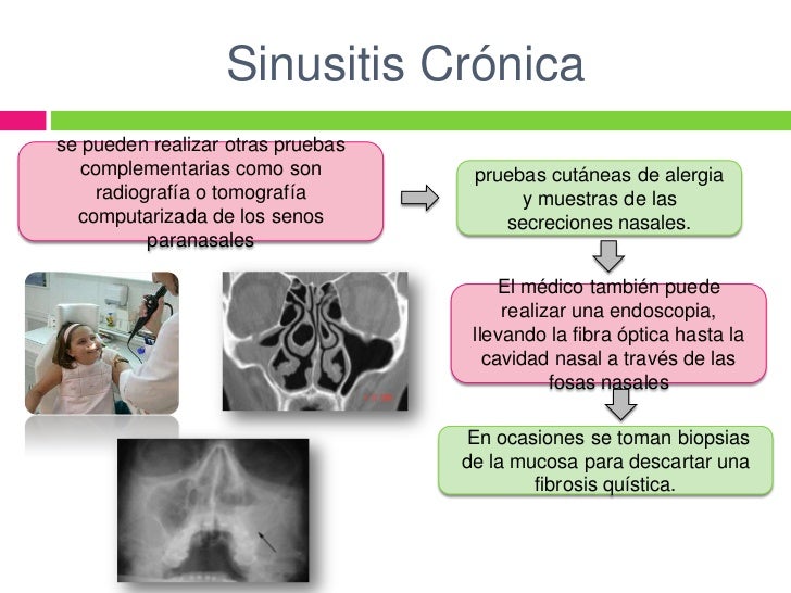 Sinusitis crónica