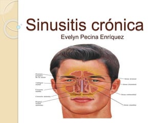 Sinusitis crónica 
Evelyn Pecina Enríquez 
 