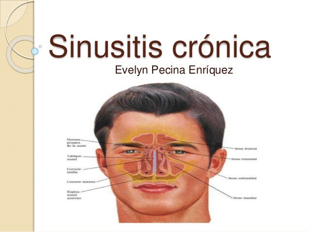 La Sinusitis Cronica Es K