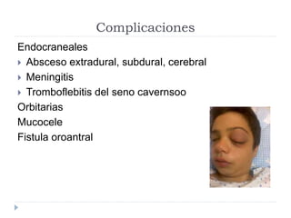 Complicaciones 
Endocraneales 
 Absceso extradural, subdural, cerebral 
 Meningitis 
 Tromboflebitis del seno cavernsoo 
Orbitarias 
Mucocele 
Fistula oroantral 
