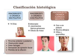 Clasificación histológica 
RINOSINUSITI 
S CRONICA 
SIN POLIPOS 
RINOSINUSITI 
S CRONICA 
CON POLIPOS 
 Rinorrea anterior o posterior 
 Obstrucción nasal 
 Dolor faringeo 
 Sensación de opresión facial 
 Pérdida de la olfación 
RINOSINUSITIS 
CRONICA 
ALÉRGICA 
MICOTICA 
 14 Días Endoscopia: 
 crecimientos 
blanco-grisaceos 
 Efecto de masa 
 Con o sin 
polipos 
 Mucina alérgica 
 Hifas y 
eosinofilos 
desgranulados 
 
