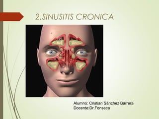 2.SINUSITIS CRONICA 
Alumno: Cristian Sánchez Barrera 
Docente:Dr.Fonseca 
 