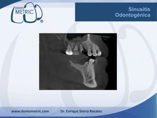 www.dentometric.com Dr. Enrique Sierra Rosales
Sinusitis
Odontogénica
 