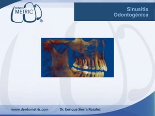 www.dentometric.com Dr. Enrique Sierra Rosales
Sinusitis
Odontogénica
 