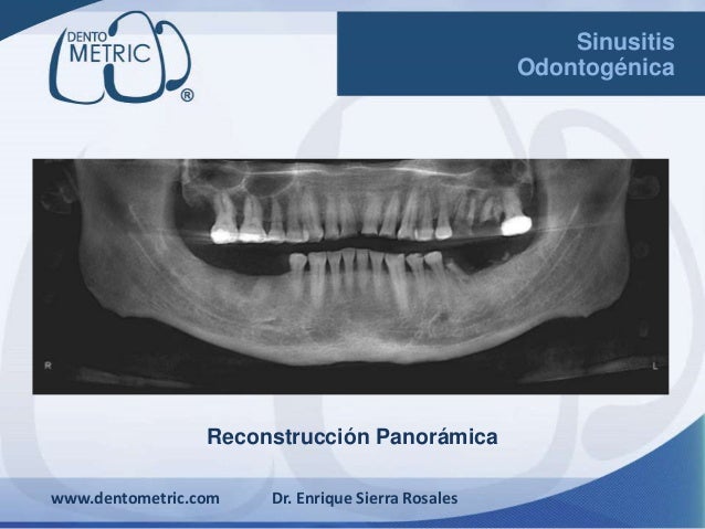 Cmo Curar La Sinusitis En Nios 6 Pasos