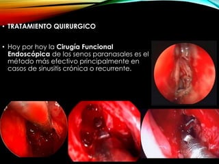 • TRATAMIENTO QUIRURGICO
• Hoy por hoy la Cirugía Funcional
Endoscópica de los senos paranasales es el
método más efectivo principalmente en
casos de sinusitis crónica o recurrente.
 