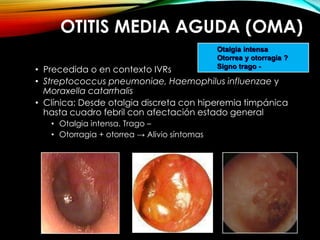 OTITIS MEDIA AGUDA (OMA)
• Precedida o en contexto IVRs
• Streptococcus pneumoniae, Haemophilus influenzae y
Moraxella catarrhalis
• Clínica: Desde otalgia discreta con hiperemia timpánica
hasta cuadro febril con afectación estado general
• Otalgia intensa. Trago –
• Otorragia + otorrea → Alivio síntomas
Otalgia intensa
Otorrea y otorragia ?
Signo trago -
 