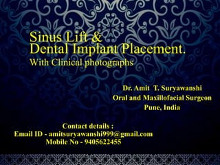 Sinus Lift & 
Dental Implant Placement. 
With Clinical photographs 
Dr. Amit T. Suryawanshi 
Oral and Maxillofacial Surgeon 
Pune, India 
Contact details : 
Email ID - amitsuryawanshi999@gmail.com 
Mobile No - 9405622455 
 