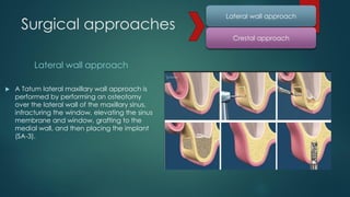 Sinus lift procedures.pptx