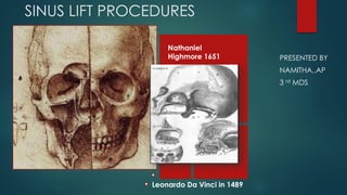SINUS LIFT PROCEDURES
PRESENTED BY
NAMITHA,.AP
3 rd MDS
Leonardo Da Vinci in 1489
Nathaniel
Highmore 1651
 