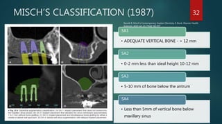 Sinus lift procedures. final copy of presentation pptx | PPTX