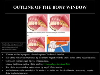 OUTLINE OF THE BONY WINDOW
• Window outline is prepared - lateral aspect of the buccal alveolus.
• Size of the window is determined by the area to be grafted in the lateral aspect of the buccal alveolus.
• Osteotomy (window) can be oval or rectangular.
• Inferior hard tissue outline of the window 3–5 mm above the sinus floor.
• Size of the upper window - determined by length of the implant.
• Mesial border can be extended as far as distal to canine, and the distal border - tuberosity - mesio-
distal implant placement.
A carbide bur is only used in thick
buccal wall for initial preparation;
then switch to a diamond
bur/piezosurgical insert.
 