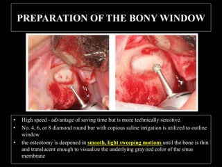 PREPARATION OF THE BONY WINDOW
• High speed - advantage of saving time but is more technically sensitive.
• No. 4, 6, or 8 diamond round bur with copious saline irrigation is utilized to outline
window
• the osteotomy is deepened in smooth, light sweeping motions until the bone is thin
and translucent enough to visualize the underlying gray/red color of the sinus
membrane
 
