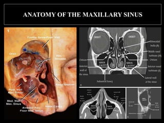 ANATOMY OF THE MAXILLARY SINUS
 