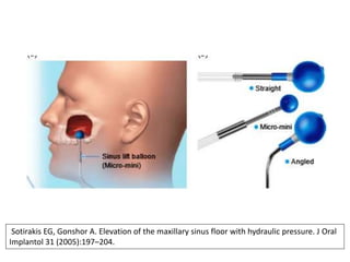 Sotirakis EG, Gonshor A. Elevation of the maxillary sinus floor with hydraulic pressure. J Oral
Implantol 31 (2005):197–204.
 