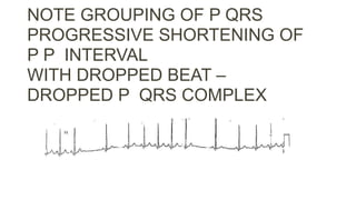NOTE GROUPING OF P QRS
PROGRESSIVE SHORTENING OF
P P INTERVAL
WITH DROPPED BEAT –
DROPPED P QRS COMPLEX
 