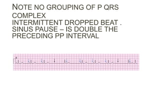 NOTE NO GROUPING OF P QRS
COMPLEX
INTERMITTENT DROPPED BEAT .
SINUS PAUSE – IS DOUBLE THE
PRECEDING PP INTERVAL
 