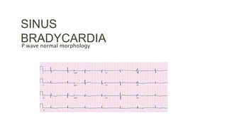 SINUS
BRADYCARDIA
P wave normal morphology
 
