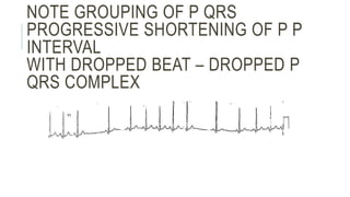 NOTE GROUPING OF P QRS
PROGRESSIVE SHORTENING OF P P
INTERVAL
WITH DROPPED BEAT – DROPPED P
QRS COMPLEX
 