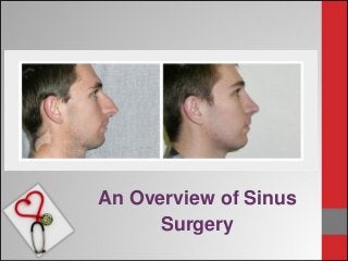 An Overview of Sinus
Surgery
 
