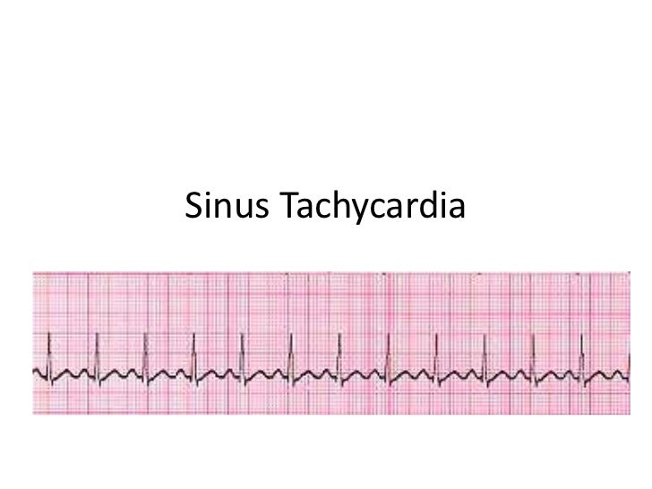 Sinus Tachycardia