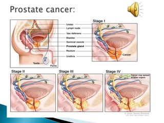 Prostate cancer: