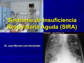 Síndrome de InsuficienciaSíndrome de Insuficiencia
Respiratoria Aguda (SIRA)Respiratoria Aguda (SIRA)
Dr. Juan Manuel Lara HernándezDr. Juan Manuel Lara Hernández
 