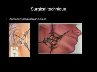 Preauricular Incision Steps Sirris materials day 2011 rapd manufacturing in medicine - prof poukens ...