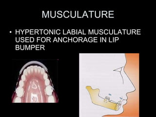 MUSCULATURE <ul><li>HYPERTONIC LABIAL MUSCULATURE USED FOR ANCHORAGE IN LIP BUMPER </li></ul>
