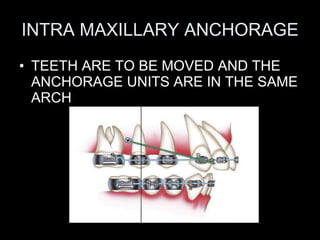 INTRA MAXILLARY ANCHORAGE <ul><li>TEETH ARE TO BE MOVED AND THE ANCHORAGE UNITS ARE IN THE SAME ARCH </li></ul>