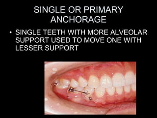 SINGLE OR PRIMARY ANCHORAGE <ul><li>SINGLE TEETH WITH MORE ALVEOLAR SUPPORT USED TO MOVE ONE WITH LESSER SUPPORT </li></ul>