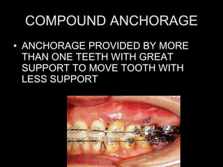 COMPOUND ANCHORAGE <ul><li>ANCHORAGE PROVIDED BY MORE THAN ONE TEETH WITH GREAT SUPPORT TO MOVE TOOTH WITH LESS SUPPORT </...
