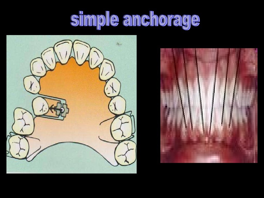 anchorage in orthodontics