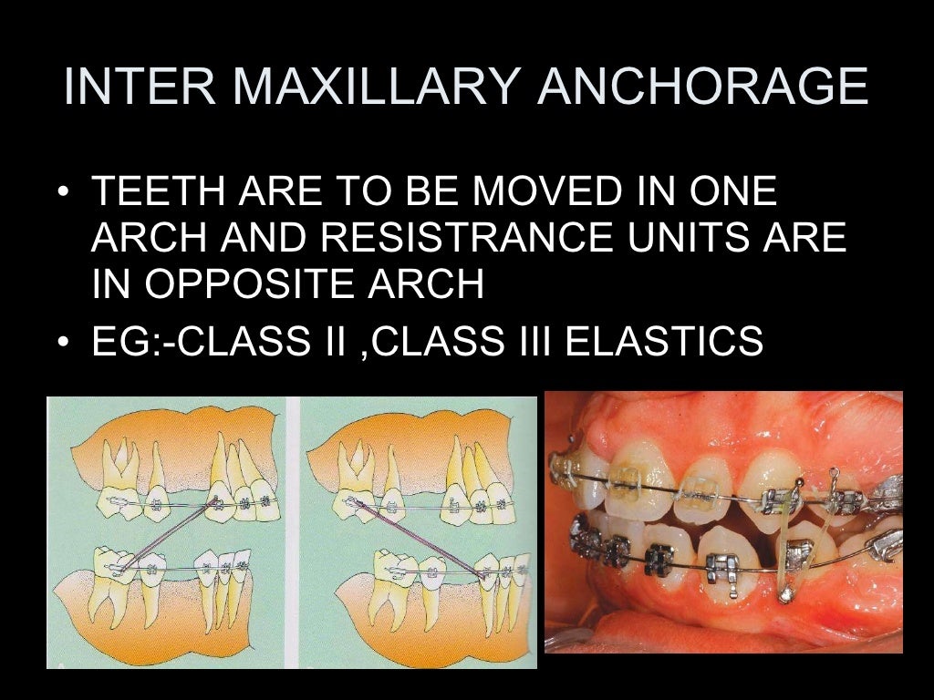 anchorage in orthodontics