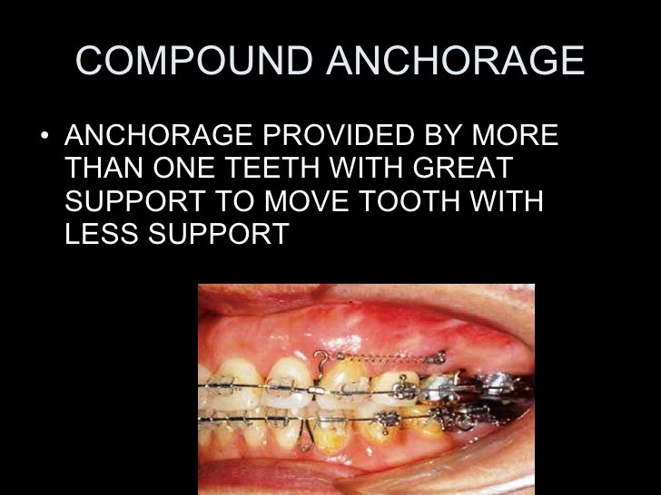 anchorage in orthodontics