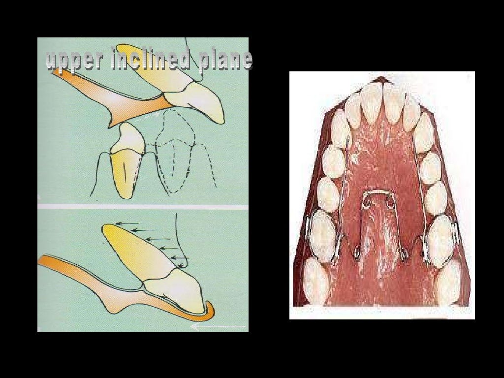 anchorage in orthodontics